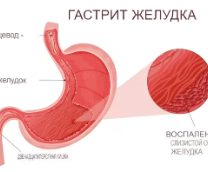 Про гастрит